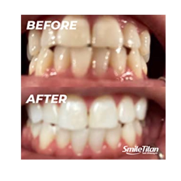 Teeth Whitening Gel Kit with 5X LED Accelerator Light and Tray Teeth Whitener - Picture 4 of 4